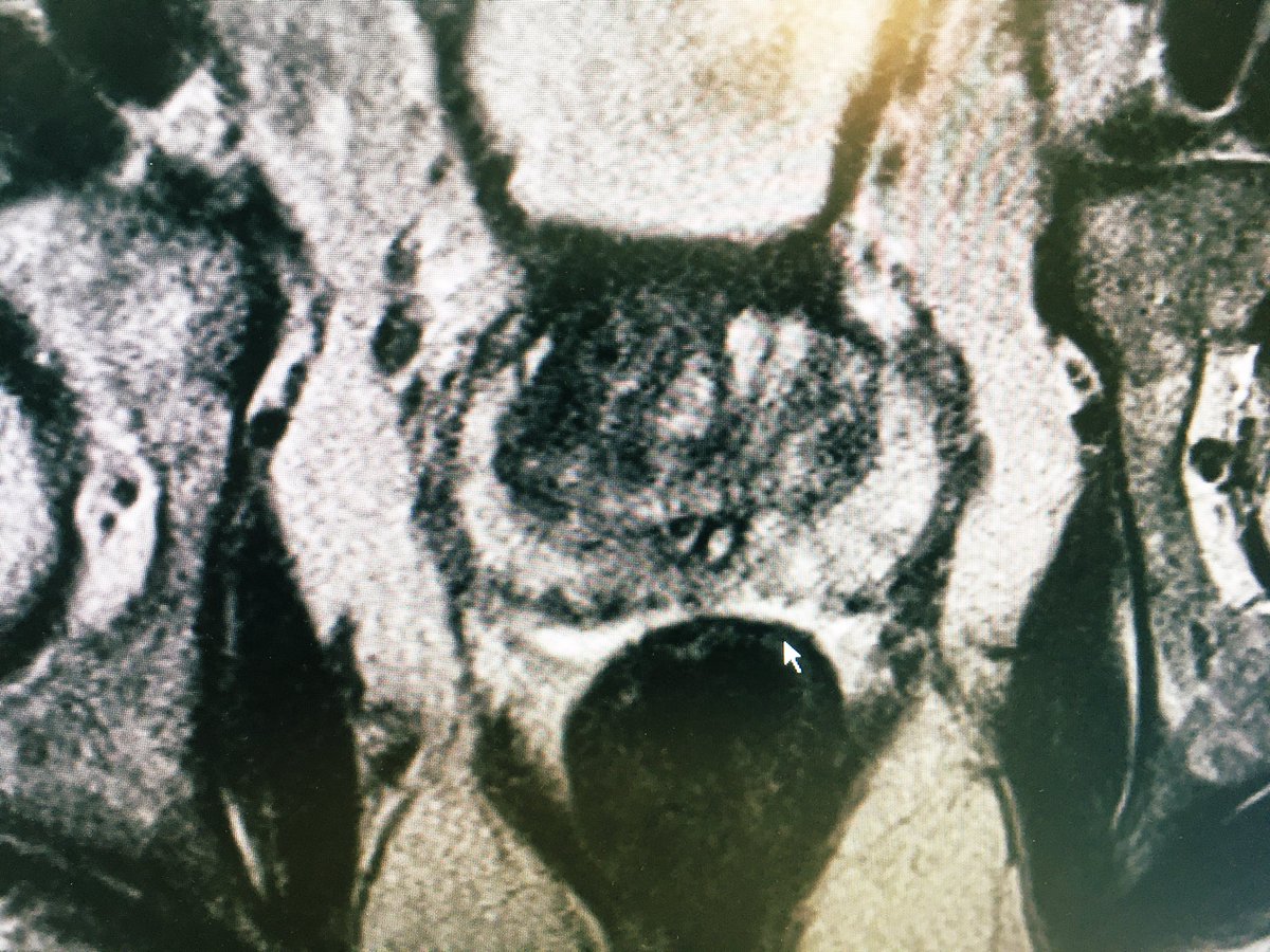 MRI heeft de risico inschatting bij verhoogd PSA enorm verbeterd. Al jaren praktijk in <a href="/antoniuszkh/">St. Antonius Ziekenhuis</a> <a href="/JelleBarentsz/">Jelle Barentsz</a> <a href="/dmsomford/">Rik Somford</a> <a href="/UrologieTwente/">Herman Roelink</a> <a href="/Selmpje/">S van Selm</a> <a href="/NOS/">NOS</a>