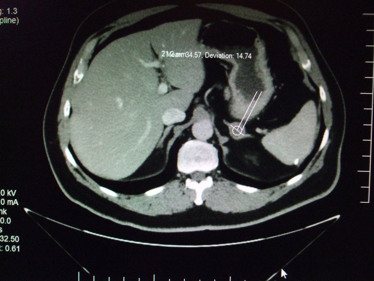 wheeloffreedom1's tweet photo. .@howiemandel @DannyWoodburn SHOCKING me in the FUCKING HEAD causing #ImmaculateConcussions &amp; EXPANDING MY STOMACH ORGANS W/ SEVERE PAIN that's caused a NEW growth on my kidney, STILL DOESN'T SCARE ME! @TheJusticeDept @FBI @realDonaldTrump @VP @tedcruz @RandPaul @SenMikeLee https://t.co/KQtGy6vFe9
