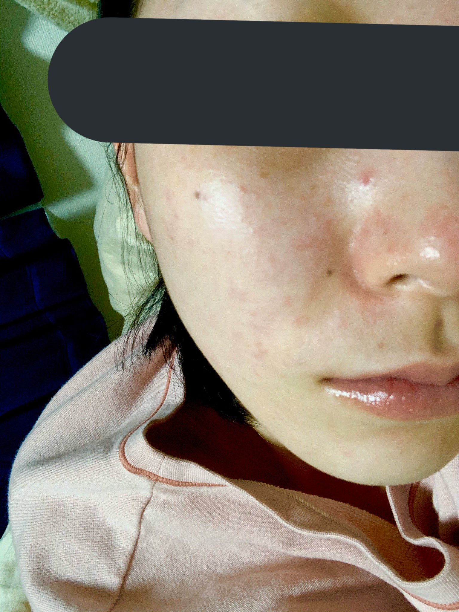 ゆ ダイエット垢 人生最大の肌荒れなんですがどうしたらいいんですか 以前の肌荒れ はハイチオールc飲んだり パックひたすらやったりしたら治ったのに何しても治らず悪化してます T T 助けて 肌荒れ おすすめのスキンケア 教えてください T