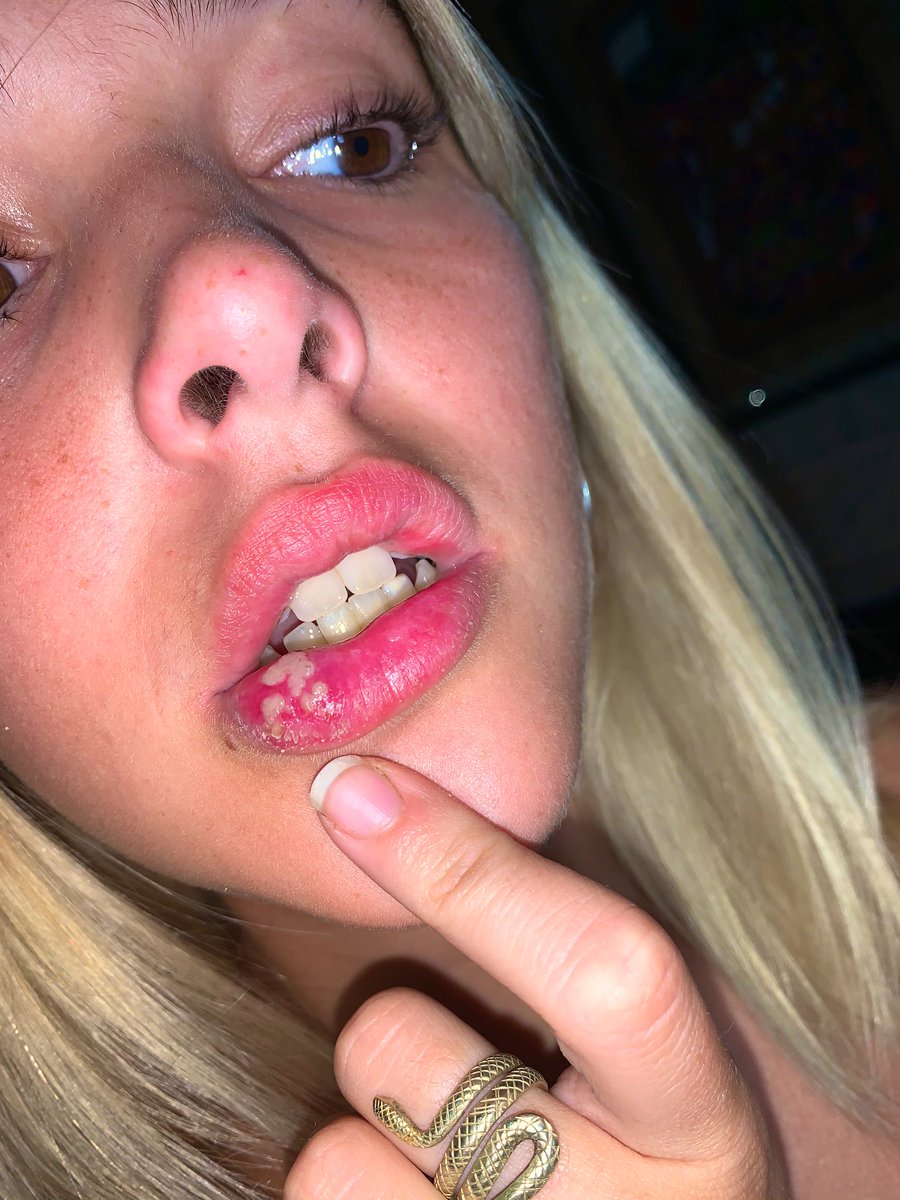 Rt para que no te salga un tremendo herpes como a mi 🙏🏻