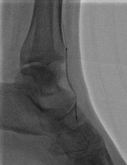 bretwiechmann's tweet image. In case you&apos;re making plans for October already. #LEARN2020 @roblookstein @paragpatel_IR @MisraMD @kmadass @SriniTummala @SIRspecialists @abbottvascular @BostonPIMedEd @VIVAPhysicians @MedtronicAPV @PhilipsHealth @bsc_pi