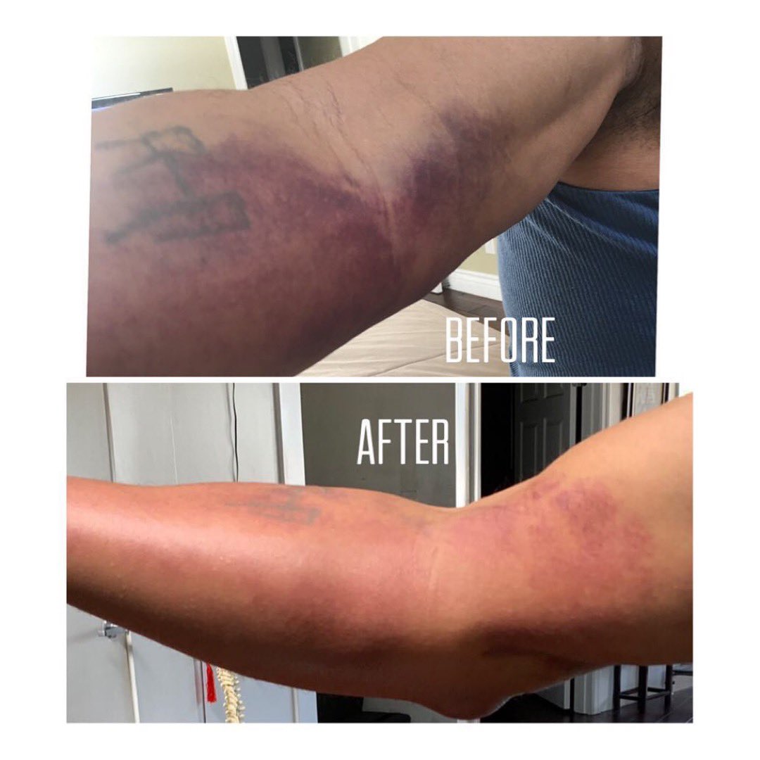WinbackUSA's tweet photo. Patient tore his bicep tendon one week ago.  Results are after 3 days of using WINBACK therapy and #hyperbaricchamber. Patient is healing ahead of schedule and the complain was very little pain.

And you what will be your story ??
#physicaltherapy #massagetherapy  #sportsmedicine https://t.co/RBt9Qtrwjv