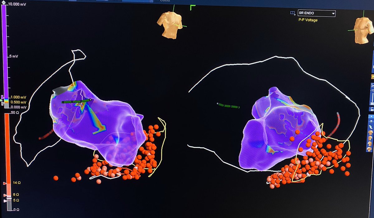 NICMP, no Endo scar. Clinical VT non inducible. What is the significance of unmappable VFL at 250 ms after extensive epicardial substrate modification? Pericardial balloon to displace phrenic nerve.  <a href="/DrRoderickTung/">Roderick Tung</a> <a href="/Dr_Santangeli/">Pasquale Santangeli</a> <a href="/JRWinterfield/">Jeffrey Winterfield</a> <a href="/True_EP/">William H. Sauer, MD</a> <a href="/KennethEllenbo1/">Kenneth Ellenbogen</a> #EPeeps