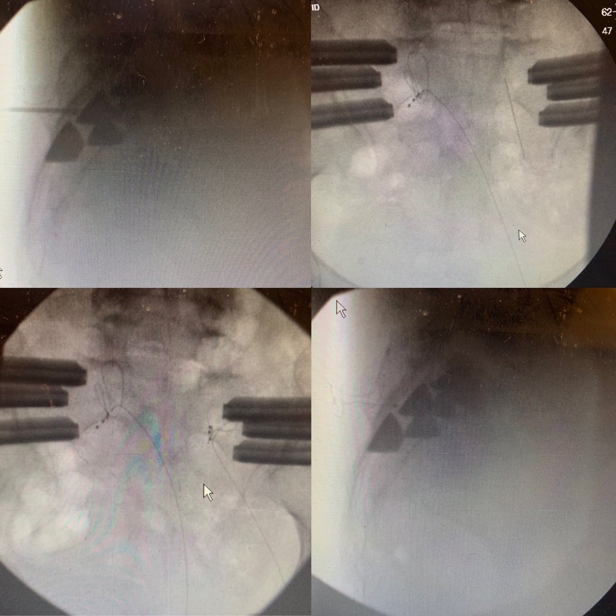 DMDickersonMD's tweet photo. #DRGstimulation after sacroiliac joint fusion and laminectomy failed to treat sacral neuralgia @AbbottGlobal @AllenBurtonMD 25g needle to localize and act as a finder prior to placement of the larger needle. Extrasacral loops due to visualization issues https://t.co/7ZJsznkRZf