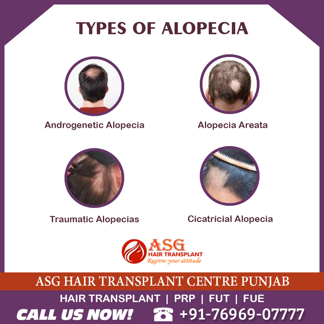 Asg Hair Transplant Asghaircare Twitter