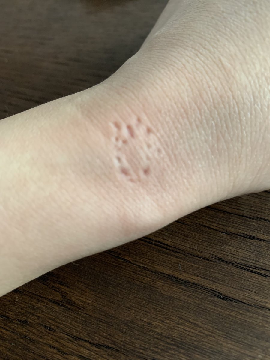 ショウガラゴのピザトル Pizzatoru うさぎに噛まれたら皮えぐれますよね 子供の頃2回ぐらいえぐられて血でましたw