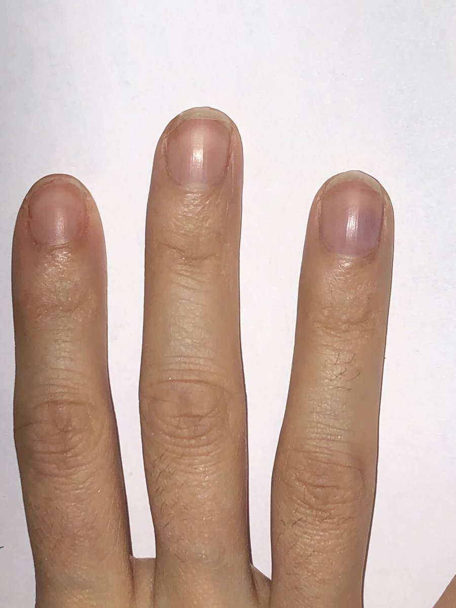 30yr old woman with 5 years finger tip pain at rest and ++ filing nails / manicure, temp sensitivity - pain occurs radiates proximally into finger. Normal NCSs and MRI CSp (but told maybe “nerve damage” 🙄 by neurologist). 5 sec exam today gave her the answer - pics show?