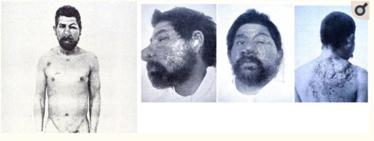 3/Here are images of the first patient diagnosed with  #Cocci, Domingo Escurra, by Alejandro Posadas  @StanDeresinski  https://www.ncbi.nlm.nih.gov/pubmed/30690606 