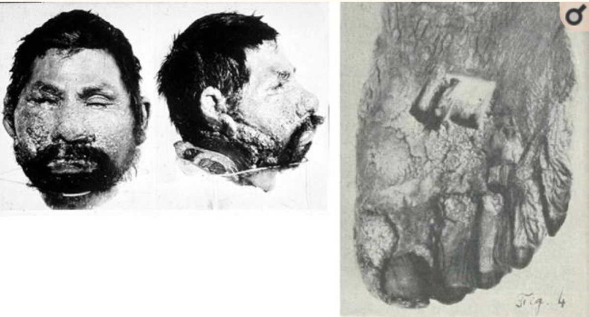 3/Here are images of the first patient diagnosed with  #Cocci, Domingo Escurra, by Alejandro Posadas  @StanDeresinski  https://www.ncbi.nlm.nih.gov/pubmed/30690606 