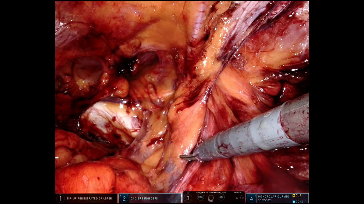 Could we expect any difference in robotic approach? #herniasurgery #herniarepair @Hospital_FJD @quironsalud @Herniadoc @abexDaVinci @IntuitiveSurg