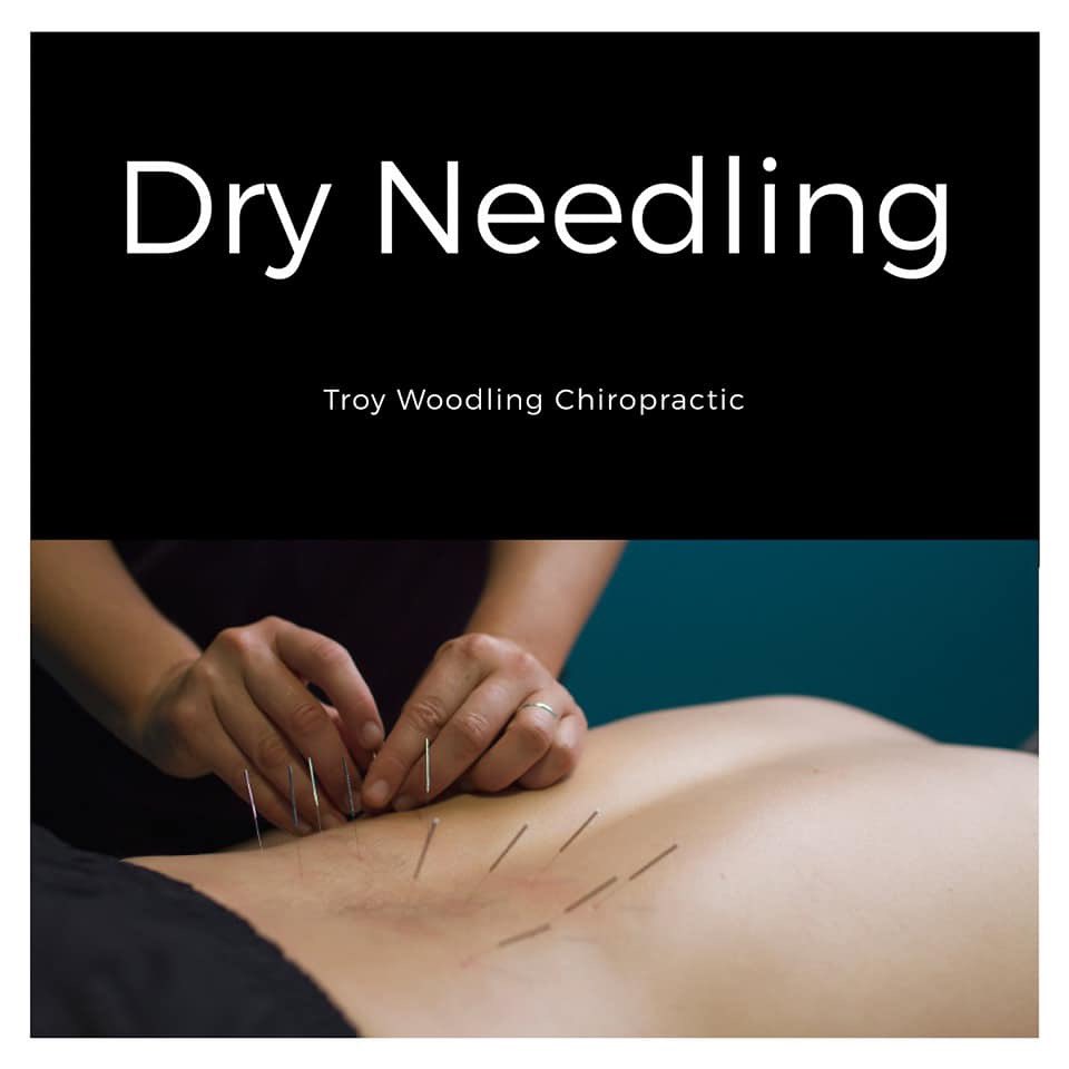 TroyWoodling's tweet photo. Dry needling is the process of using thin, dry needles and inserting them into muscular trigger points. This service is used to reduce muscular spasms and strains as well as eliminate pain! Call us at 334-566-5295 to learn more or to schedule this amazing service today! https://t.co/qLxTq4DHUB