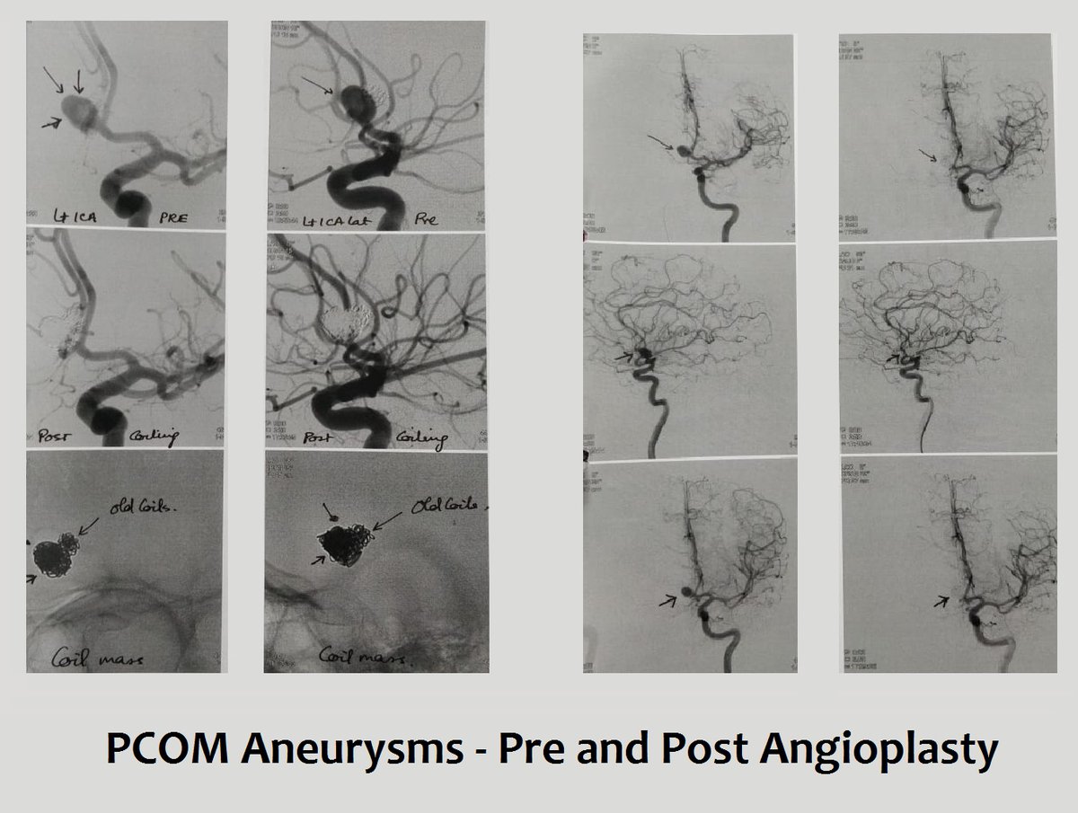 DrPNRenjen's tweet photo. Another day of #stroke at Apollo. 🧠
PCOM Aneurysms treatment pre and post #angioplasty results.
#neurocare #preandpost #PCOMAneurysms #treated @dr_dinesh_c #neurology #ApolloHospitalDelhi https://t.co/TiEPuOCI0U