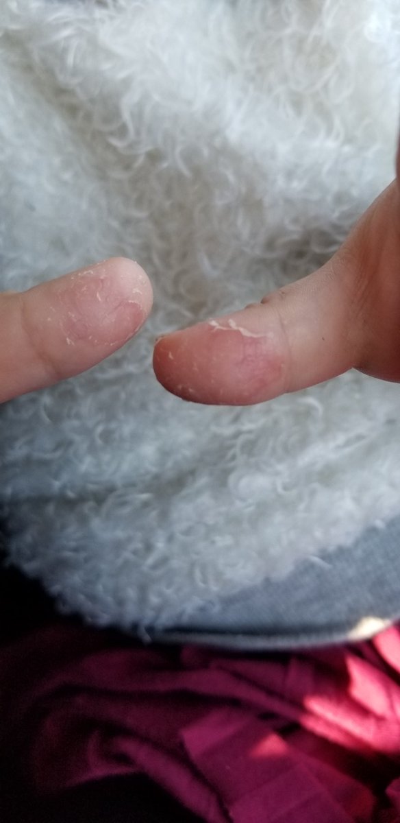 指の皮が剥ける