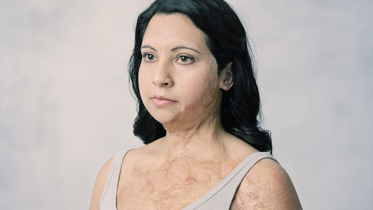 image of woman who has scarring on the skin on the side of her one, chest and shoulder from what appears to be a burn