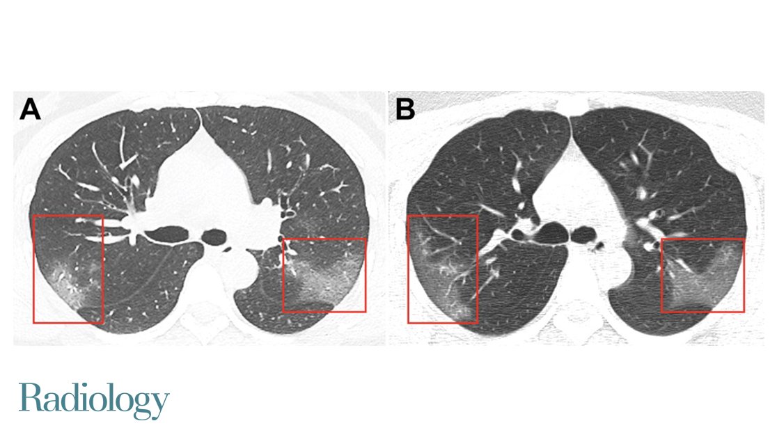 BREAKING: 2019 Novel Coronavirus (2019-nCoV) CT findings are featured in this new Images in Radiology. bit.ly/38U3U5f #CoronaVirus