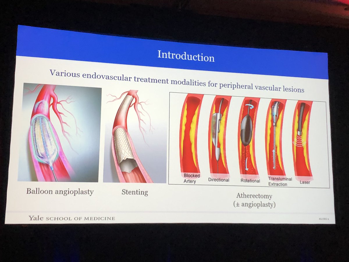 ColemanDM_vasc's tweet photo. Propensity matching of @VascularSVS #VQI data - #athrectomy assoc w/ improved 1y fem-pop primary patency compared to angioplasty; no difference in clinical outcome (although athrectomy rarely stand-alone). More work needed - From @YaleVascular’s @arash_fere and team. #VESS2020 https://t.co/pe4STOjm8p