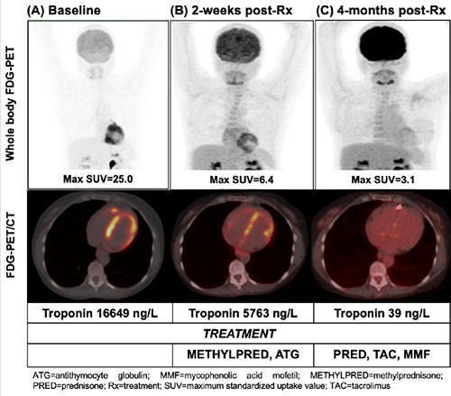 CircImaging (@circimaging) on Twitter photo Serial FDG PET imaging of giant cell myocarditis, showing potential utility of PET for early diagnosis and management. <a href="/BeanlandsRob/">Rob Beanlands</a> <a href="/venkmurthy/">Venk Murthy MD PhD</a> <a href="/ZainabASamad/">Zainab Samad</a> #AHAJournals ow.ly/NfAk50ya6Bh Serial FDG PET imaging of giant cell myocarditis, showing potential utility of PET for early diagnosis and management. <a href="/BeanlandsRob/">Rob Beanlands</a> <a href="/venkmurthy/">Venk Murthy MD PhD</a> <a href="/ZainabASamad/">Zainab Samad</a> #AHAJournals ow.ly/NfAk50ya6Bh