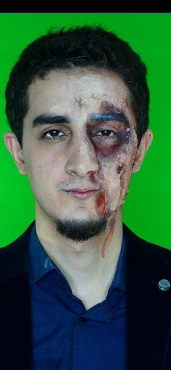 #AllahRahmetEylesinRuhiÇenet
Arkadaşlar  virüs  anında  böyle yapıyormuş, herkes  yanında  sirke taşısın  bakın bu çokomelli.