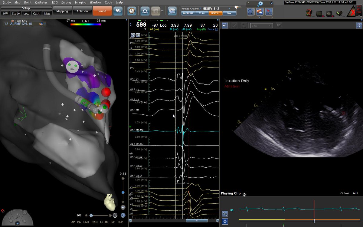 finnakerstrom's tweet photo. @MDTolgaAksu @andresenriqueza @DrFerminGarcia @ALFIEEP1 @CarinaHardy4 Anterolateral PM in the end! Look at the microelectro signals from the #QDotmicro (-52ms) https://t.co/K9myavEZD1