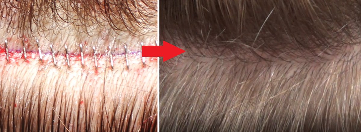 Does hair transplant surgery leave a scar? If so, is it visible? Where is the scar located? What can be done to camouflage the scar? If you are curious about .. fellermedical.com/does-a-hair-tr…