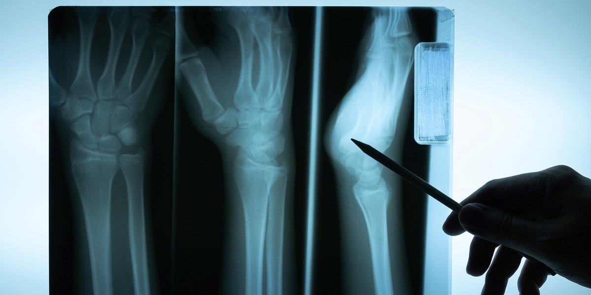 A close up of an x-ray of a hand.