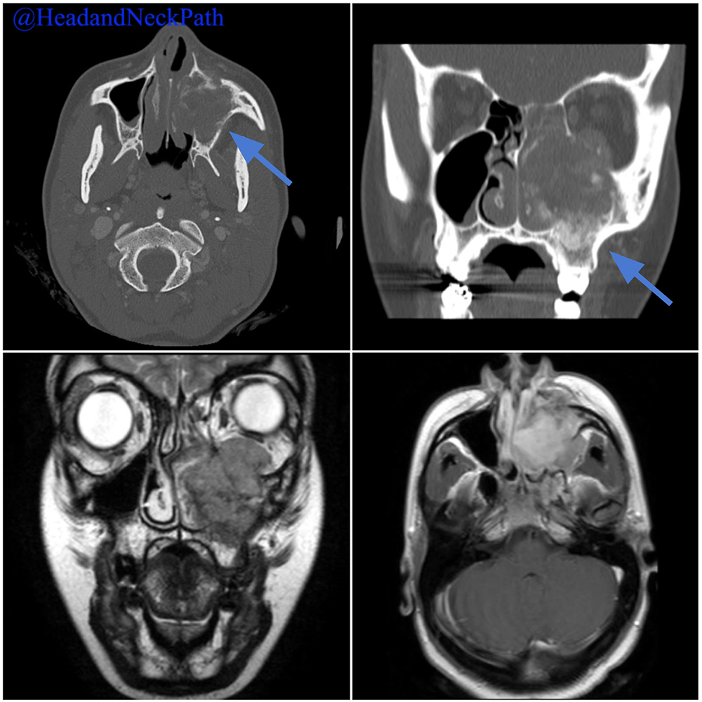 Soft Tissue Special Issue: Imaging of Bone and Soft Tissue Sarcomas in the Head and Neck by Ngoc-Anh Tran, Jeffrey P. Guenette &amp; Jyothi Jagannathan: 
link.springer.com/article/10.100…

#HeadNeckPathol #HNPJ #HeadandNeckPath #Pathology #ENTPath #PathologyTweet