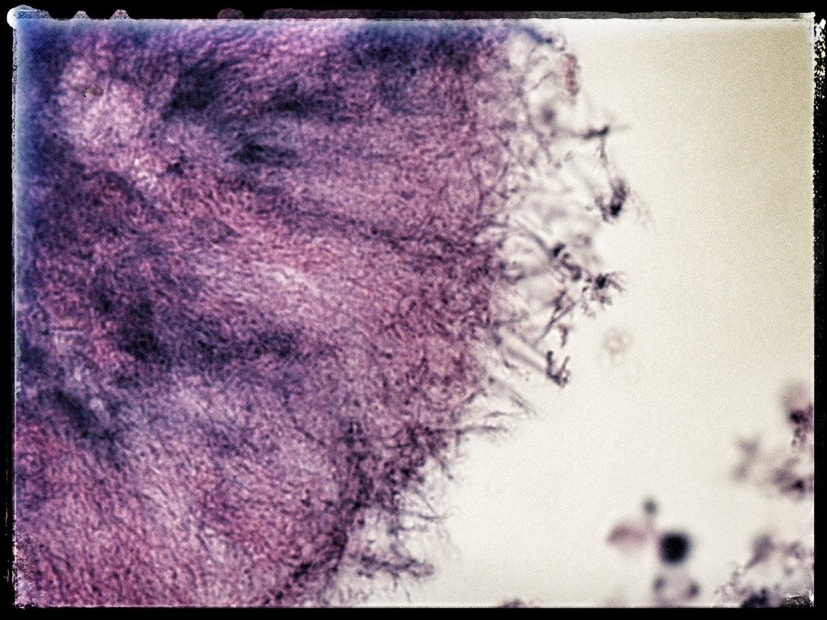 oreoimc's tweet photo. ➡️This is a first for me! Aspirate of liver lesion.
➡️ Multiple hepatic  lesions present
➡️ Aspirate is purluent ,green and foul smelling. 
➡️Also multiple pulmonary nodules . An interesting case 
➡️Cell block and surepath https://t.co/fuaUx6TaGz