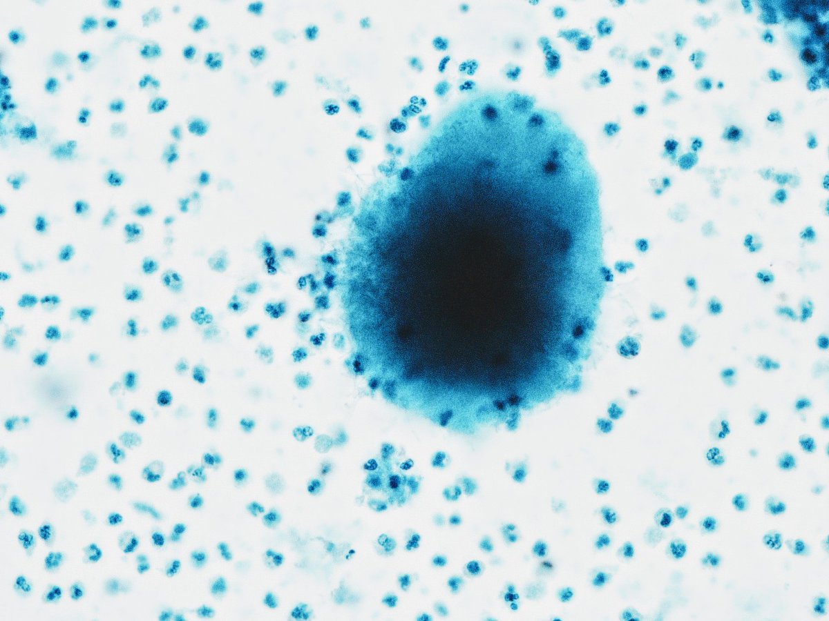 oreoimc's tweet photo. ➡️This is a first for me! Aspirate of liver lesion.
➡️ Multiple hepatic  lesions present
➡️ Aspirate is purluent ,green and foul smelling. 
➡️Also multiple pulmonary nodules . An interesting case 
➡️Cell block and surepath https://t.co/fuaUx6TaGz