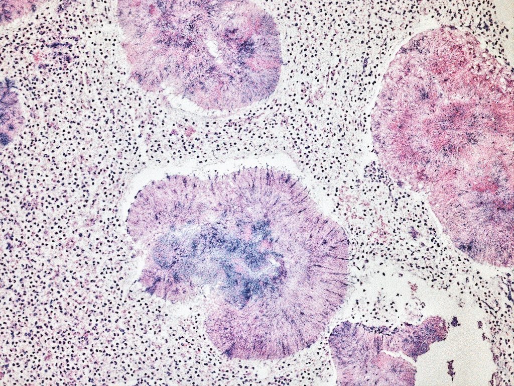 oreoimc's tweet photo. ➡️This is a first for me! Aspirate of liver lesion.
➡️ Multiple hepatic  lesions present
➡️ Aspirate is purluent ,green and foul smelling. 
➡️Also multiple pulmonary nodules . An interesting case 
➡️Cell block and surepath https://t.co/fuaUx6TaGz