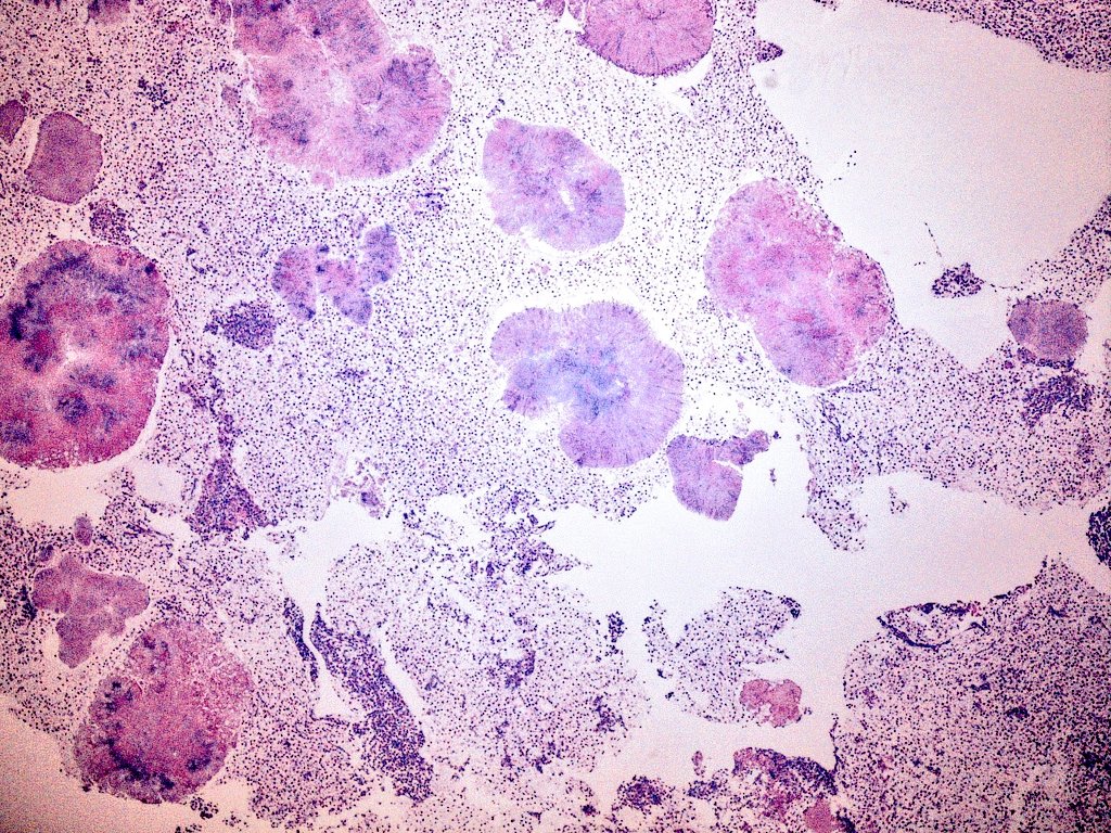 oreoimc's tweet photo. ➡️This is a first for me! Aspirate of liver lesion.
➡️ Multiple hepatic  lesions present
➡️ Aspirate is purluent ,green and foul smelling. 
➡️Also multiple pulmonary nodules . An interesting case 
➡️Cell block and surepath https://t.co/fuaUx6TaGz