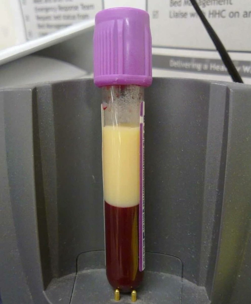 Whether you believe it or not, this is blood collected from a patient.The upper part is lipids(fat), this person had very high levels of fat in their blood including cholesterolSome people inherit this kind of condition, others get it because of their lifestyle