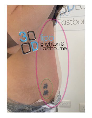 #fatfreeze #crylipolysis #beforeandafter #3dlipo #3dlipoeastbourne #bodytransformation #weightloss #eastbourne