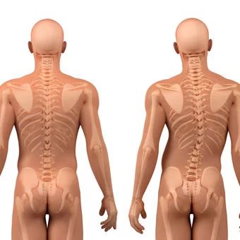 DrSusmitNaskar's tweet photo. ♠️ What is #scoliosis ?
▫️
▫️
♠️ Scoliosis is a lateral curvature or deviation (right or left) of the spine more than 10, and associated with rotation of vertebra. Follow for more: https://t.co/u0kooLZaSQ
▫️
▫️
#InvasiveSpineSurgery #SpineSurgery #Sciatica #SlippedDisc #NeckPain https://t.co/4Dpxru3GTh