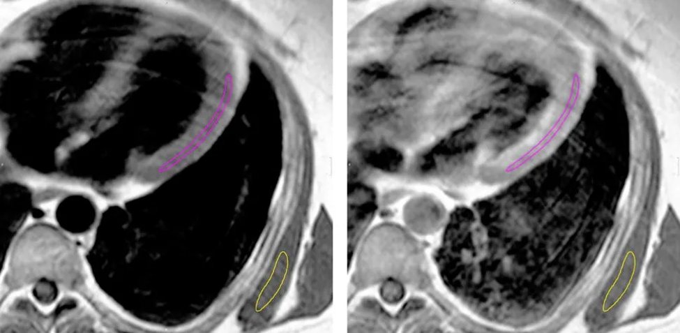 Study demonstrated increased amount of arterial hypertension in their #inclusionbodymyositis cohort but not in primary #heart muscle #inflammation.
#myositis #Cardiology #rheumatology #Neurology 
link.springer.com/article/10.100…