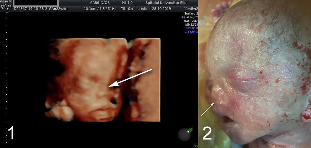 database_image's tweet photo. 📸 Prenatal diagnosis of maxillonasal dysplasia

#BindersSyndrome #maxillofacialhypoplasia #mentalretardation

🔎 https://t.co/MvsCw8io5W

Publishing was never more straightforward! https://t.co/FH9oBQphCa