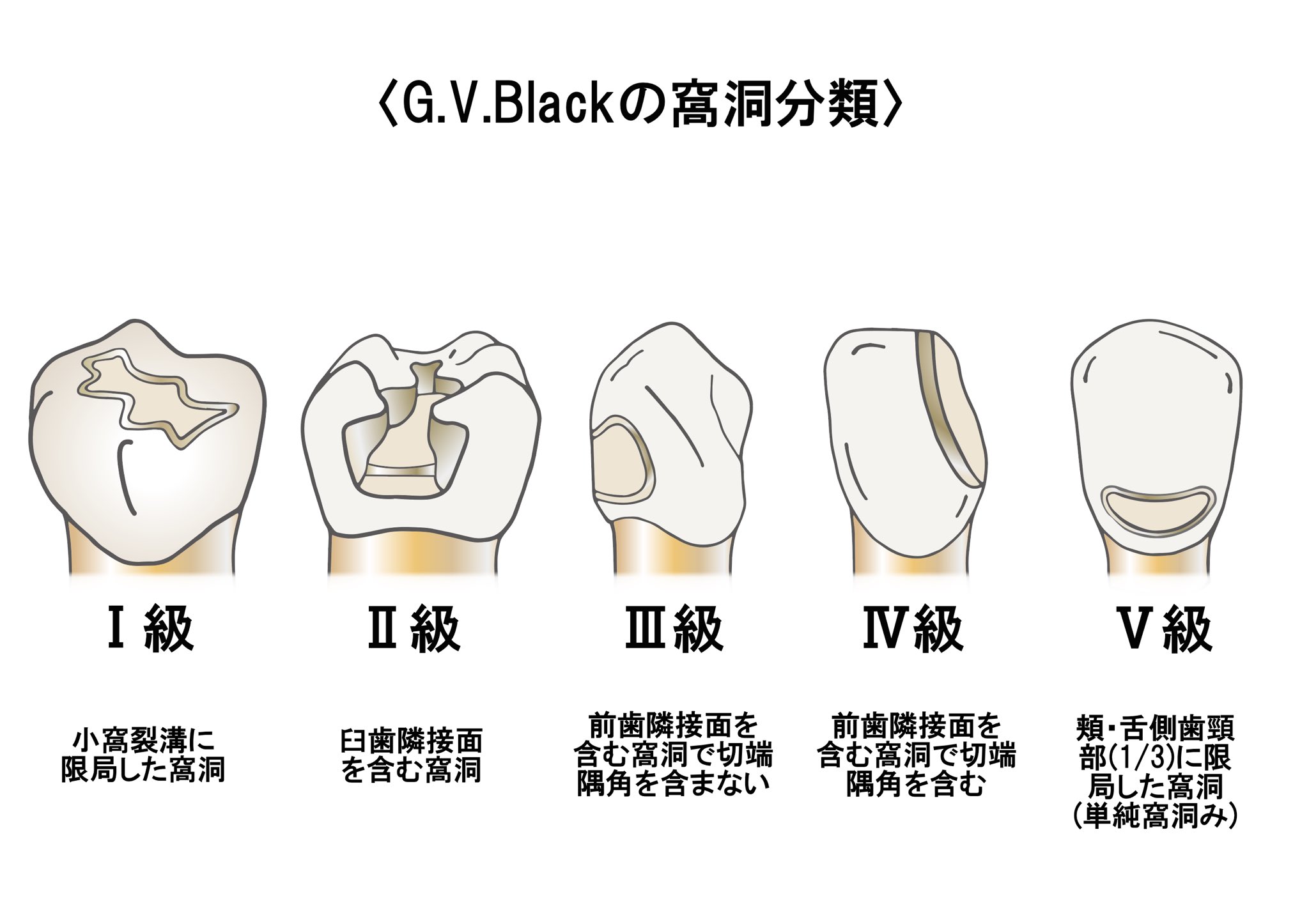 歯科衛生士のための一問一答 Blackの窩洞分類 級 小窩裂溝に限局 級 臼歯隣接面を含む 級 前歯隣接面 隅角含まない 級 前歯隣接面 隅角含む 級 歯頸部1 3に限局