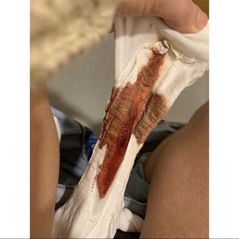 Red_Dot_Project's tweet photo. End Period shame. We bleed every cycle...get used to it. If this image makes you uncomfortable, this is the perfect time to dive deep into why it makes you feel that way. Embrace the blood! Be proud to bleed! #endperiodshame #periodpositive #noshame #dealwithit https://t.co/JZ2HyBA5Ws