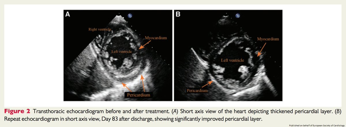 ESC_Journals's tweet photo. Hepatomegaly + PUO + Known Sickle Cell Disease may not always equate to hepatic sequestration crisis. Find out how #echofirst &amp; #whyCMR helped clinch the dx https://t.co/Vwy2Kbt80a

 @cfcamm @s_gati @johncamm #openaccess #EHJCaseReports #ESCardioEd #CardioTwitter https://t.co/bv16PIwppQ