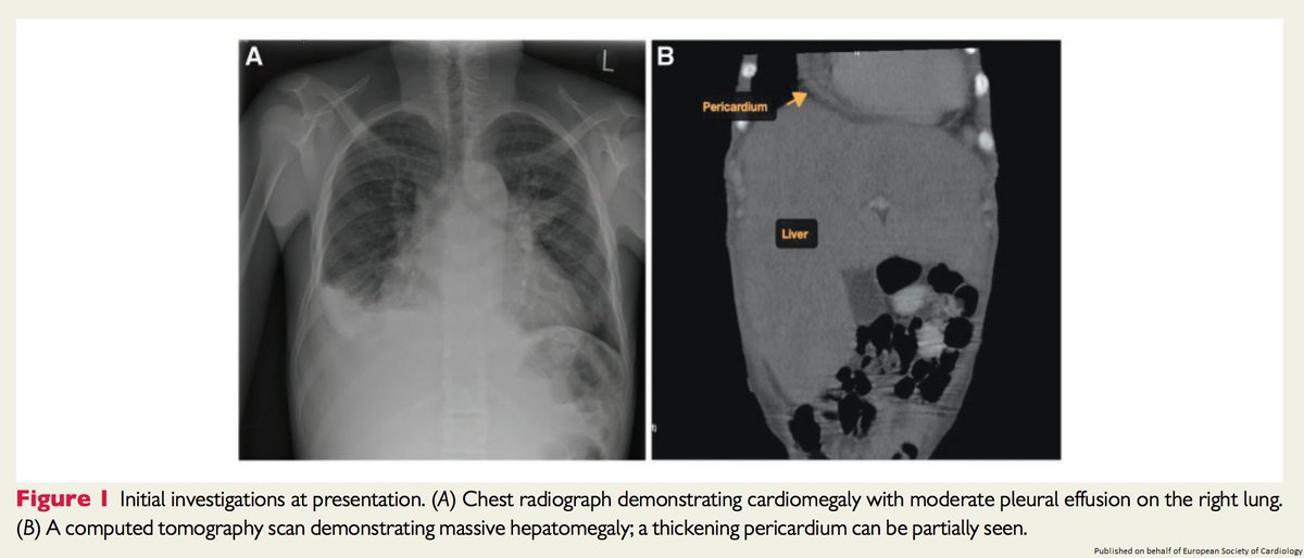 ESC_Journals's tweet photo. Hepatomegaly + PUO + Known Sickle Cell Disease may not always equate to hepatic sequestration crisis. Find out how #echofirst &amp; #whyCMR helped clinch the dx https://t.co/Vwy2Kbt80a

 @cfcamm @s_gati @johncamm #openaccess #EHJCaseReports #ESCardioEd #CardioTwitter https://t.co/bv16PIwppQ