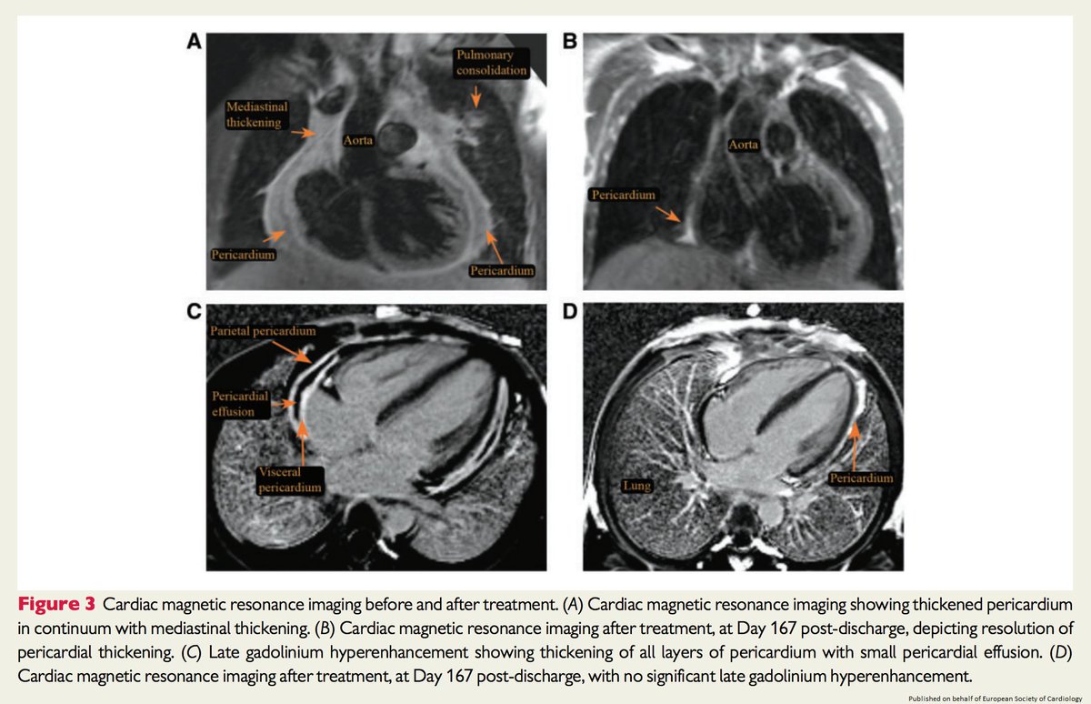 ESC_Journals's tweet photo. Hepatomegaly + PUO + Known Sickle Cell Disease may not always equate to hepatic sequestration crisis. Find out how #echofirst &amp; #whyCMR helped clinch the dx https://t.co/Vwy2Kbt80a

 @cfcamm @s_gati @johncamm #openaccess #EHJCaseReports #ESCardioEd #CardioTwitter https://t.co/bv16PIwppQ