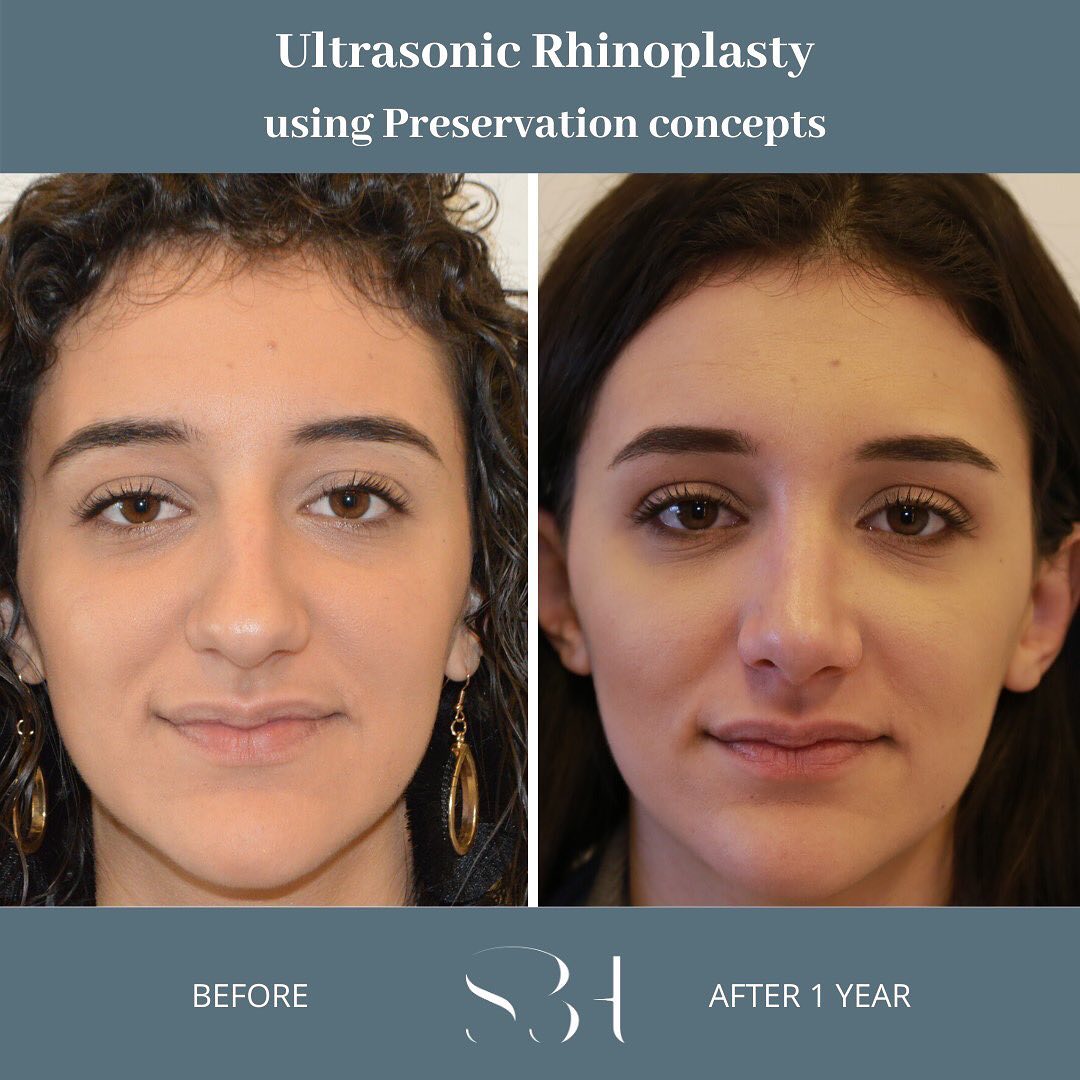 NYC Rhinoplasty (Nose Surgery) Before and After Pictures - Upper East Side