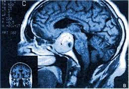 sociedadSEEN's tweet image. From pituitary adenoma to pituitary neuroendocrine tumor: an International Pituitary Pathology Club proposal
Terminología #PitNET: coherente con la utilizada para otros TNE y reconoce el impacto variable de estos tumores en los pacientes
ow.ly/uw3P30qhBRs