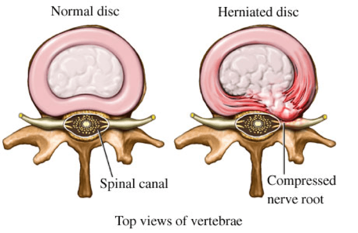 DrSusmitNaskar's tweet photo. ✔️ Artificial #Spine #LumbarDisc Replacement in India
▫️
▫️
✔️ Are you suffering from spinal or any other related pain? Request an appointment with Dr. #SusmitNaskar today. Visit https://t.co/bH9ibCgx1v for appointment.
▫️
▫️
✔️ #SpineLumbarDisc https://t.co/GvgfQiIuEt