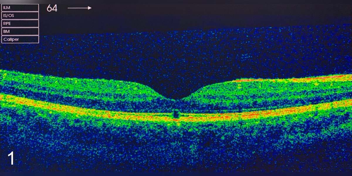 database_image's tweet photo. 📸 Ocular coherence tomography showing retinal damage from handheld green diode laser pointer
🔍https://t.co/kyCScNWe2z
#lasermaculopathy #retinaldamage
#Greendiodelaserpointer #ophthalmology https://t.co/3ZkIHdkCxB