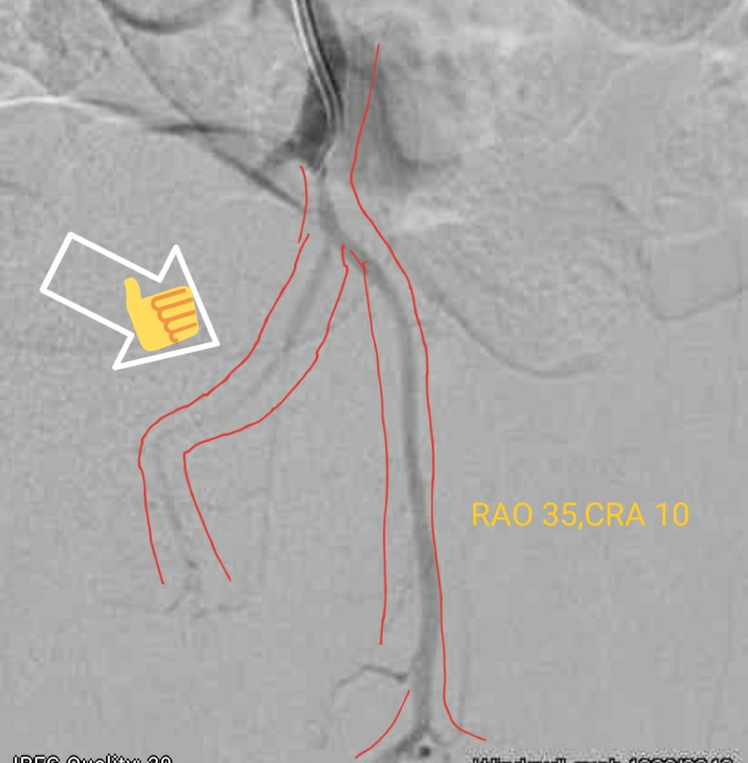 Sahil Mehta (@svmehtamd) on Twitter photo Ipsilateral is usually best but to locate origins but sometimes not. Troubleshooting with cone beam or contralateral can be super helpful for #pae like this one whose origin was hidden in the usual ipsi view
<a href="/BIDMCRad/">BIDMC Department of Radiology</a> <a href="/SIRRFS/">SIR RFS</a> <a href="/SIRspecialists/">Society of Interventional Radiology</a> <a href="/StreamMeeting/">STREAMmeeting</a> Ipsilateral is usually best but to locate origins but sometimes not. Troubleshooting with cone beam or contralateral can be super helpful for #pae like this one whose origin was hidden in the usual ipsi view
<a href="/BIDMCRad/">BIDMC Department of Radiology</a> <a href="/SIRRFS/">SIR RFS</a> <a href="/SIRspecialists/">Society of Interventional Radiology</a> <a href="/StreamMeeting/">STREAMmeeting</a>