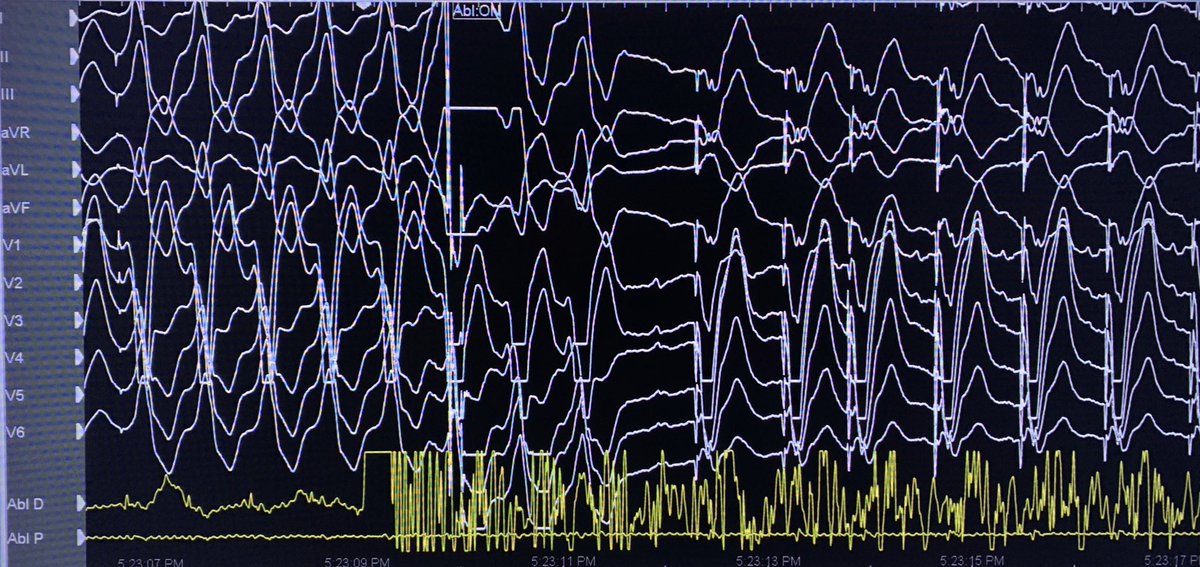 Dr_Santangeli's tweet photo. Incessant septal VT - earliest activity recorded from a multipolar Grid catheter within the RCC not seen by the ablation catheter. Do septal VT fail because of inadequate mapping or lack of more powerful ablation tools? #Epeeps @PennCardiology https://t.co/Akg0CYlLMf