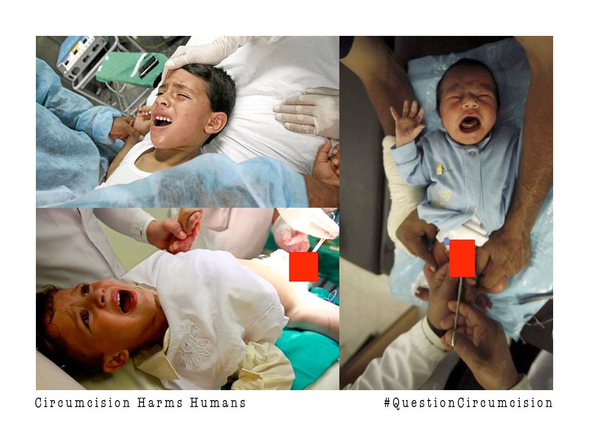 MassBayIntact's tweet image. Circumcision Harms Humans.

#Circumcision #EndChildCircumcision #EndInfantCircumcision #ForeskinLove
#GenitalAutonomy
#Trauma
#MedEd

youtube.com/watch?v=Ec92eR…
