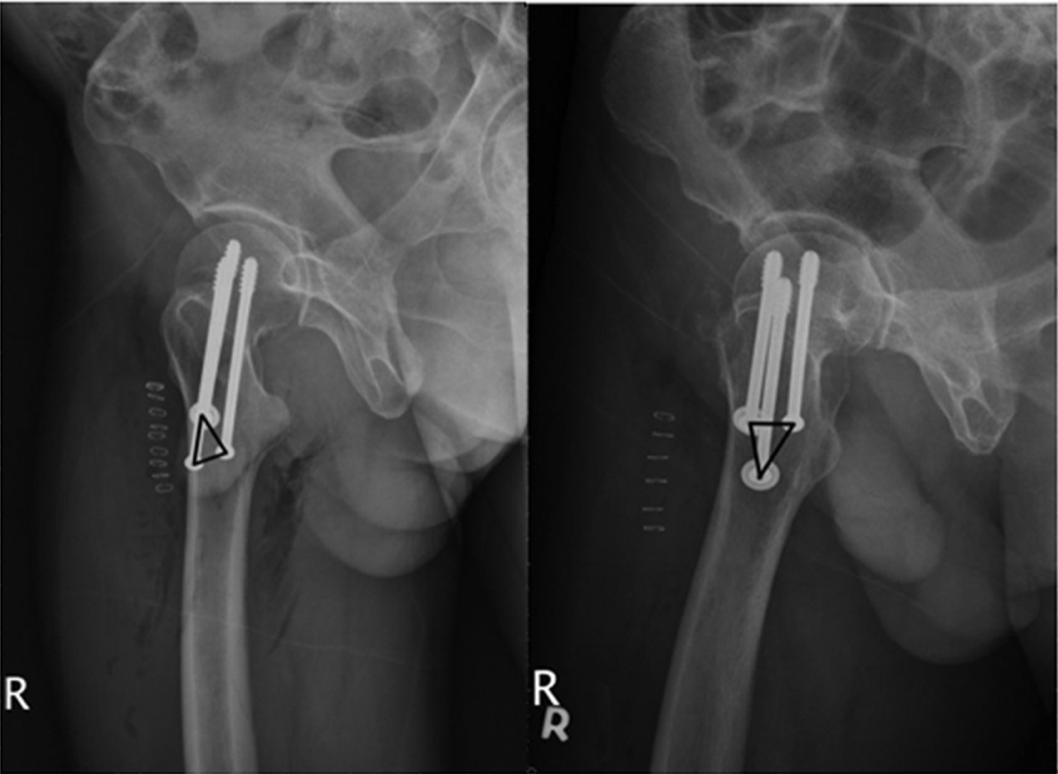 Risk Factors for Nonunion in Patients with Intracapsular Femoral Neck Fractures Treated with Three Cannulated Screws Placed in Either a Triangle or an Inverted Triangle Configuration

ow.ly/gLrc50yjDV5