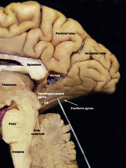 DrBaskaya's tweet photo. Access to the #atrium of lateral #ventricle lesions via #Supracerebellar transtentorial #transcollateral sulcus #approach
https://t.co/J4AzPkmWvj
@uw_neurosurgery @UWHealth @uwsmph @ElsevierConnect @sciencedirect
#skullbase #neuroanatomy #nsgy #microsurgery #Technique #training https://t.co/jwbcpTGD9K
