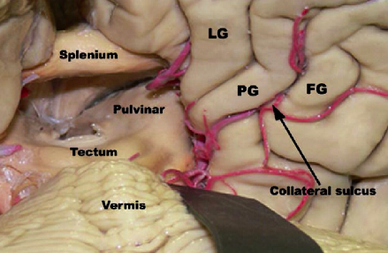DrBaskaya's tweet photo. Access to the #atrium of lateral #ventricle lesions via #Supracerebellar transtentorial #transcollateral sulcus #approach
https://t.co/J4AzPkmWvj
@uw_neurosurgery @UWHealth @uwsmph @ElsevierConnect @sciencedirect
#skullbase #neuroanatomy #nsgy #microsurgery #Technique #training https://t.co/jwbcpTGD9K